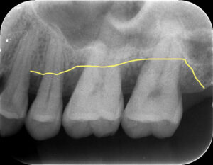 心斎橋　歯周病の進行　口腔内写真　レントゲン　歯槽骨の状態確認　
