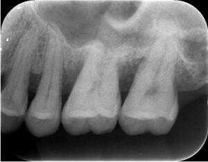 心斎橋　歯周病の進行　口腔内写真　レントゲン　歯槽骨の状態確認　