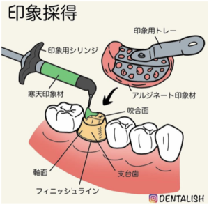 心斎橋　歯医者　型取りの方法　被せ物　歯科