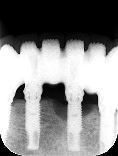 心斎橋　歯医者　インプラント周囲の骨がなくなっています。