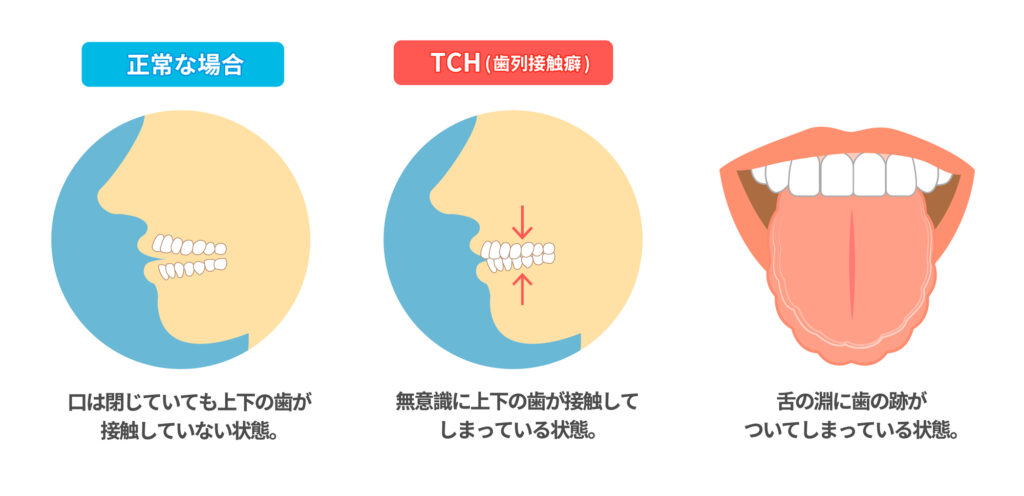 歯列接触癖のイメージ