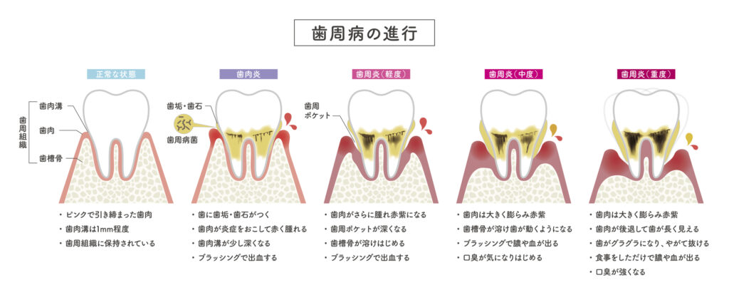歯周病進行図