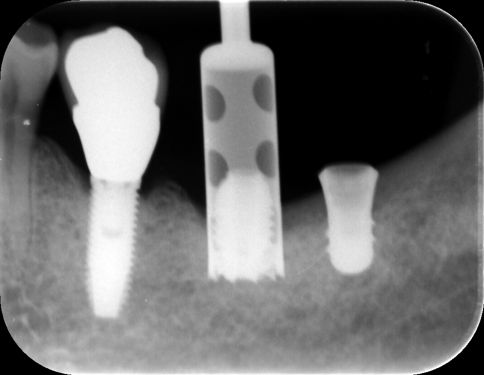 インプラント除去の様子