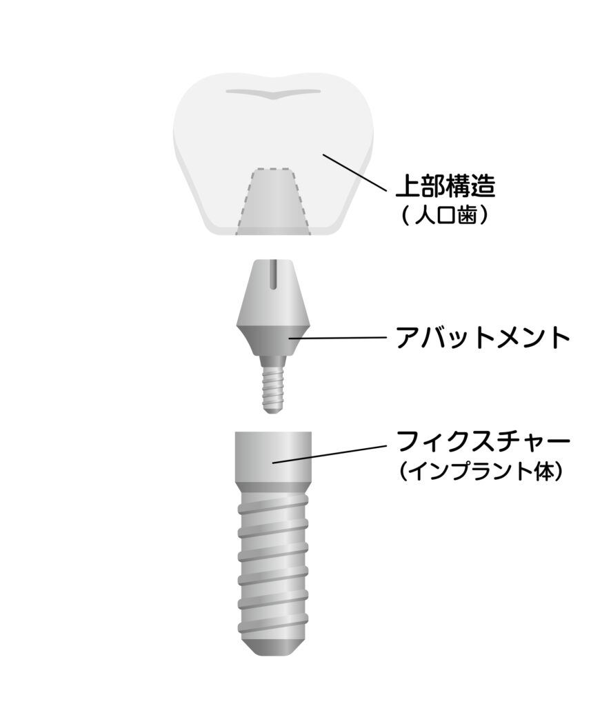 インプラントの基本的な構造