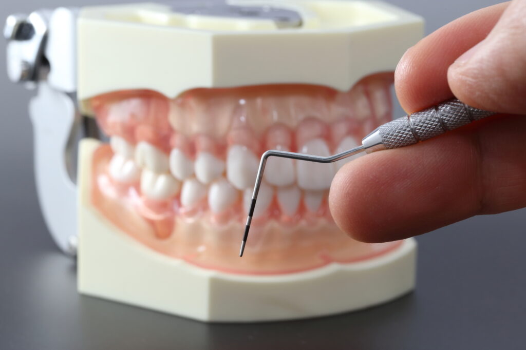 心斎橋　歯医者　歯周病ポケット