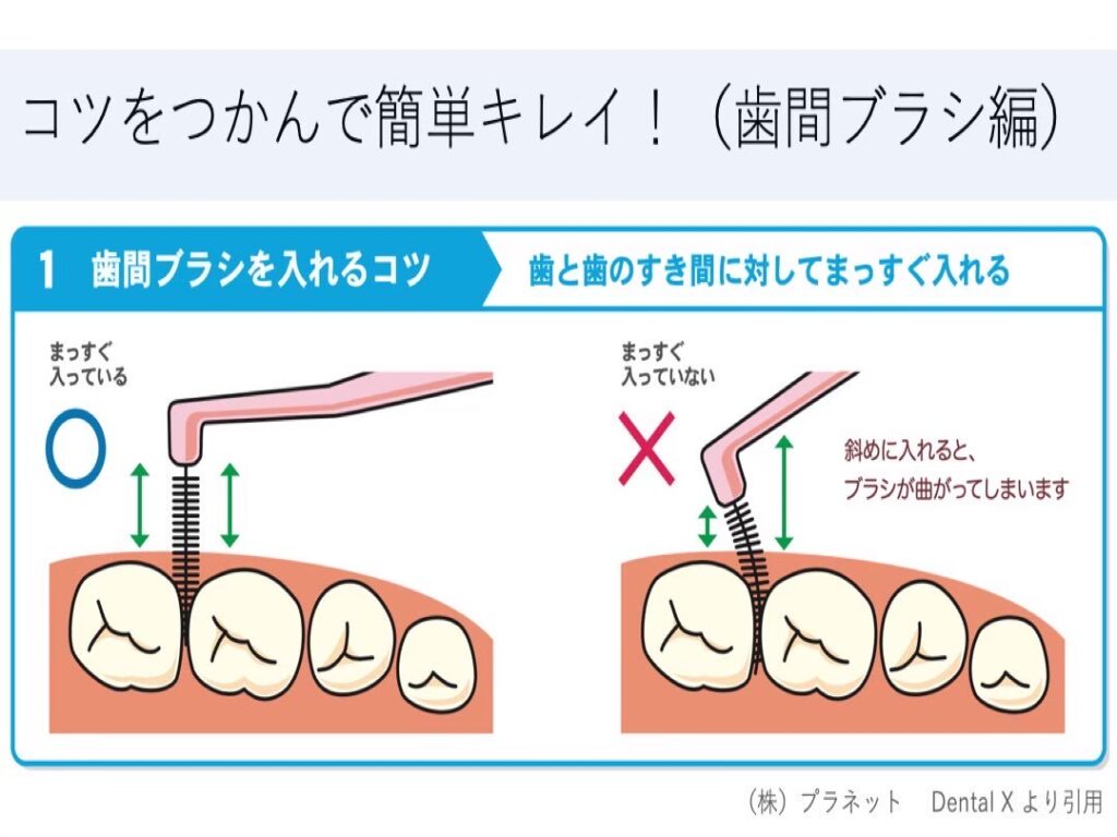 心斎橋　歯医者　歯と歯の間は適切なサイズの歯間ブラシを使用する。