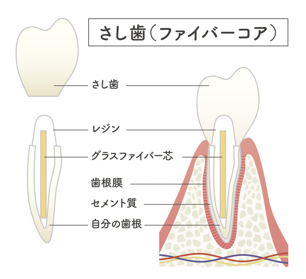 さし歯（ファイバーコア）