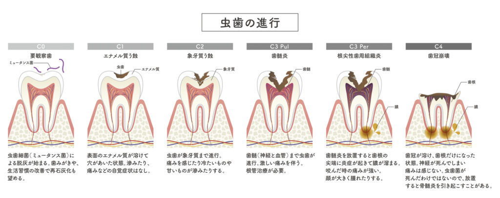 虫歯の進行