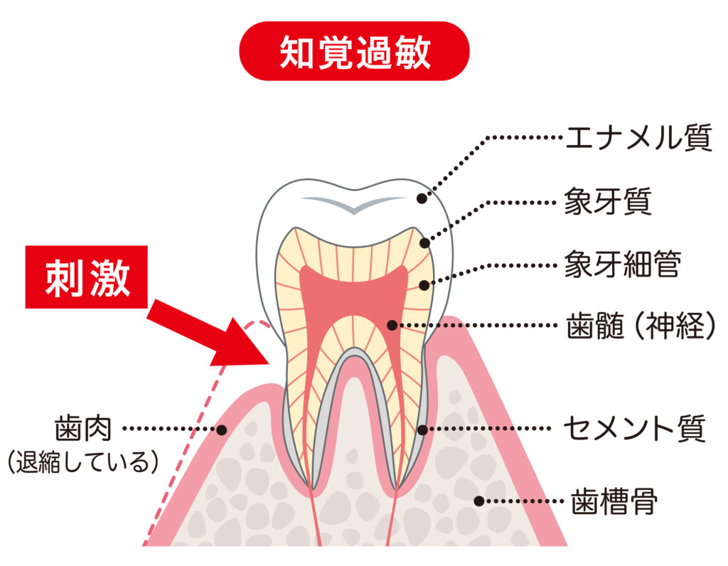 知覚過敏のイメージ