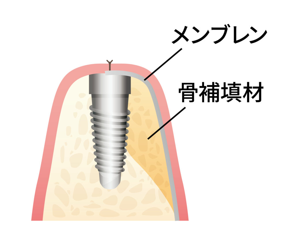 メンブレンと骨補填材