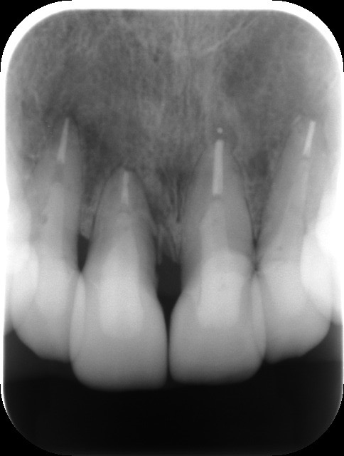 右上の前歯が歯根破折