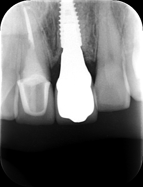 インプラント治療のレントゲン写真