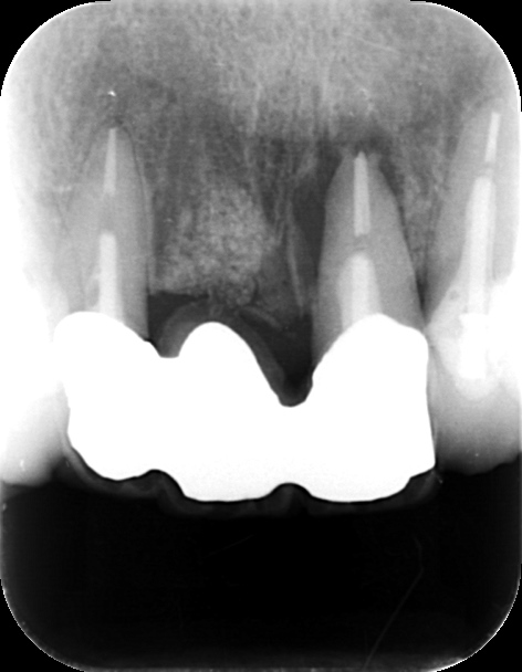ブリッジ装着後３年で起きた歯根破折