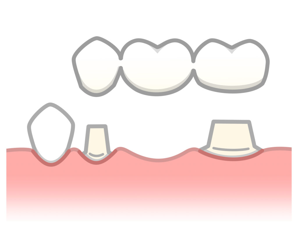 歯のブリッジ