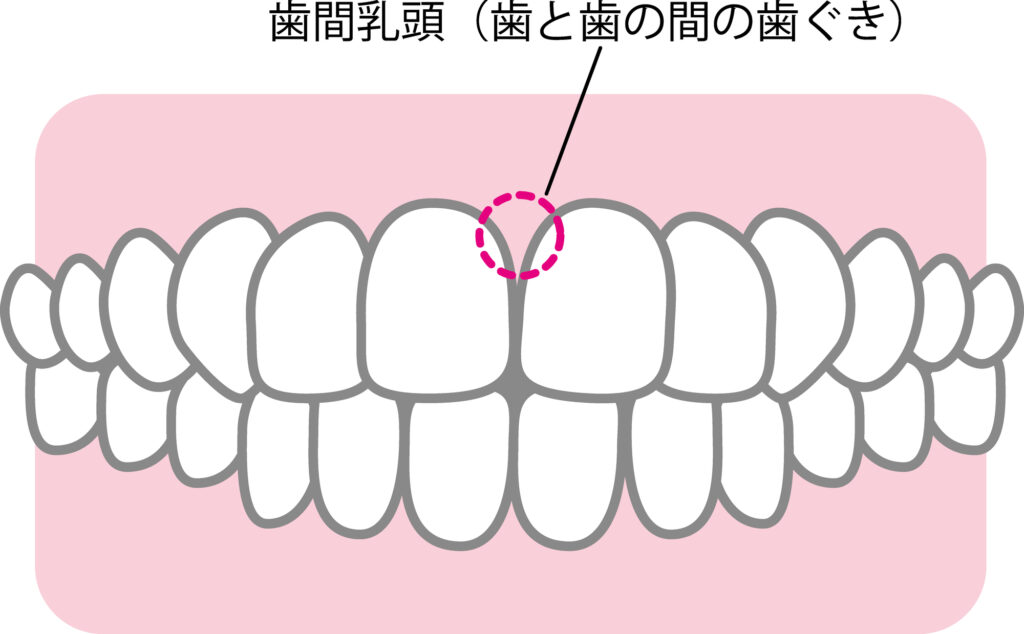 歯間乳頭にできた隙間