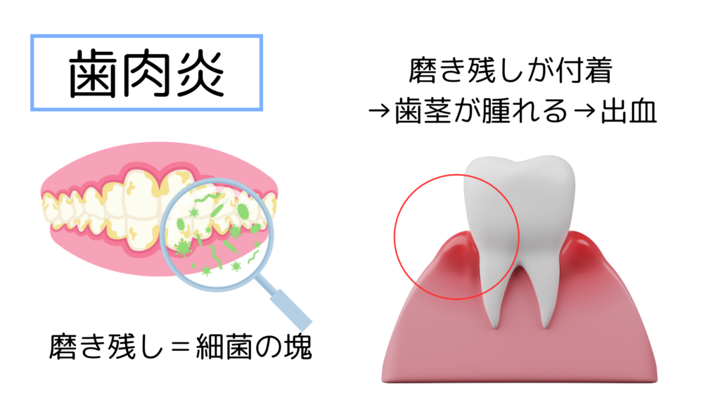 歯肉炎