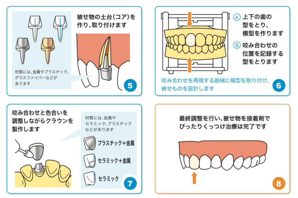 差し歯