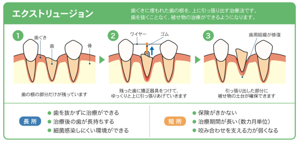 エクストリュージョン