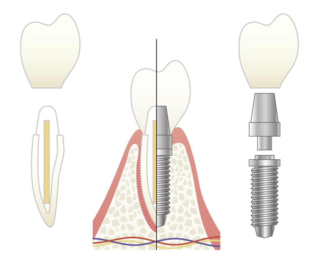 インプラントのイメージ図