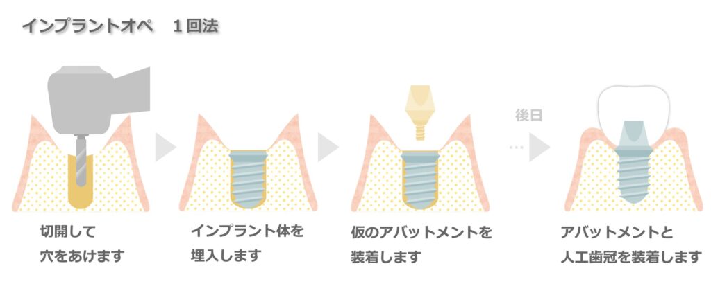インプラント手術の流れ
