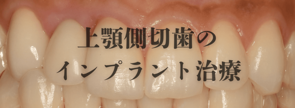 上顎側切歯