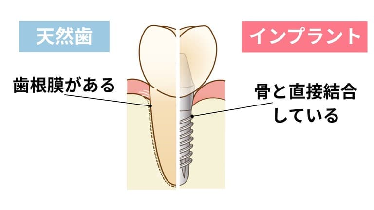 天然の歯とインプラントの違い