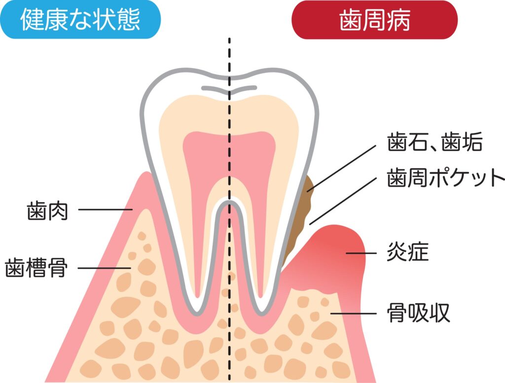 歯周ポケットと歯石の関係性
