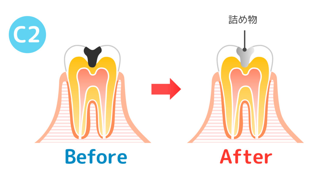 虫歯治療前と治療後の歯のイメージ