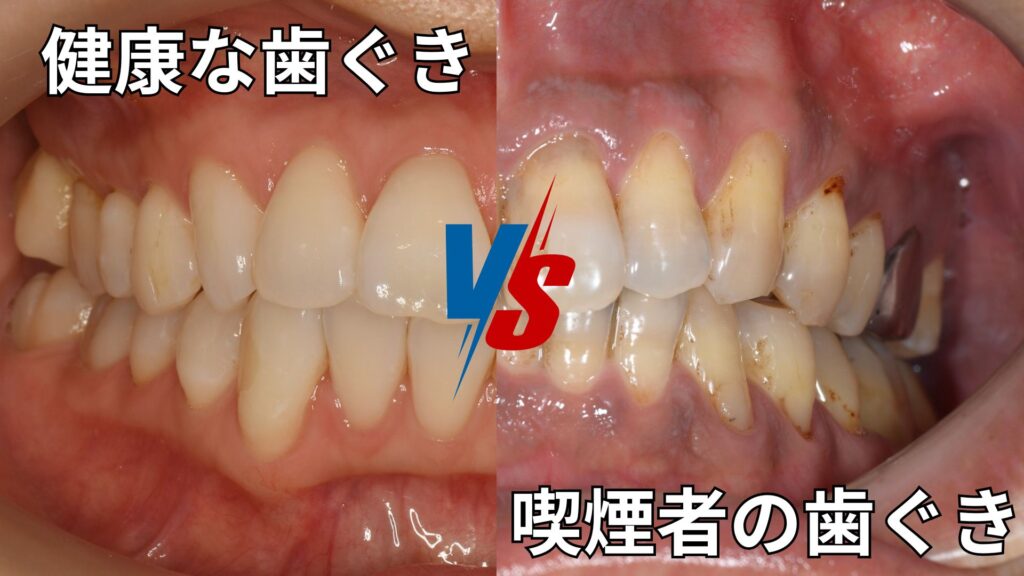 健康な歯茎と喫煙者の歯茎