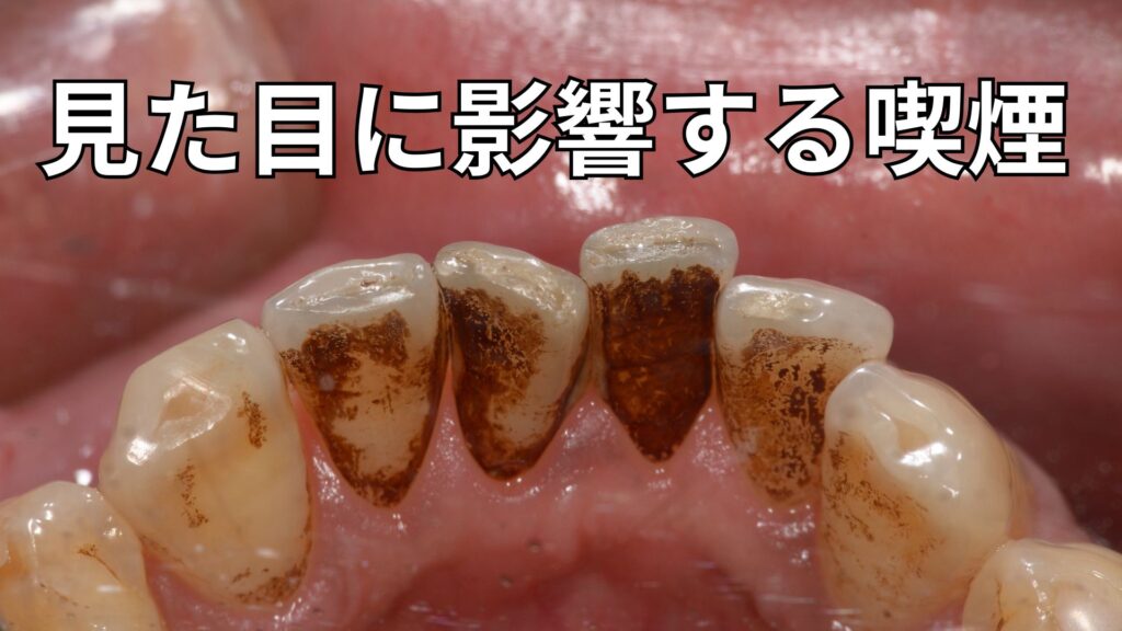 ヤニが付着した口腔内