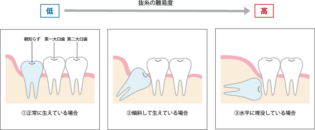 抜歯の難易度