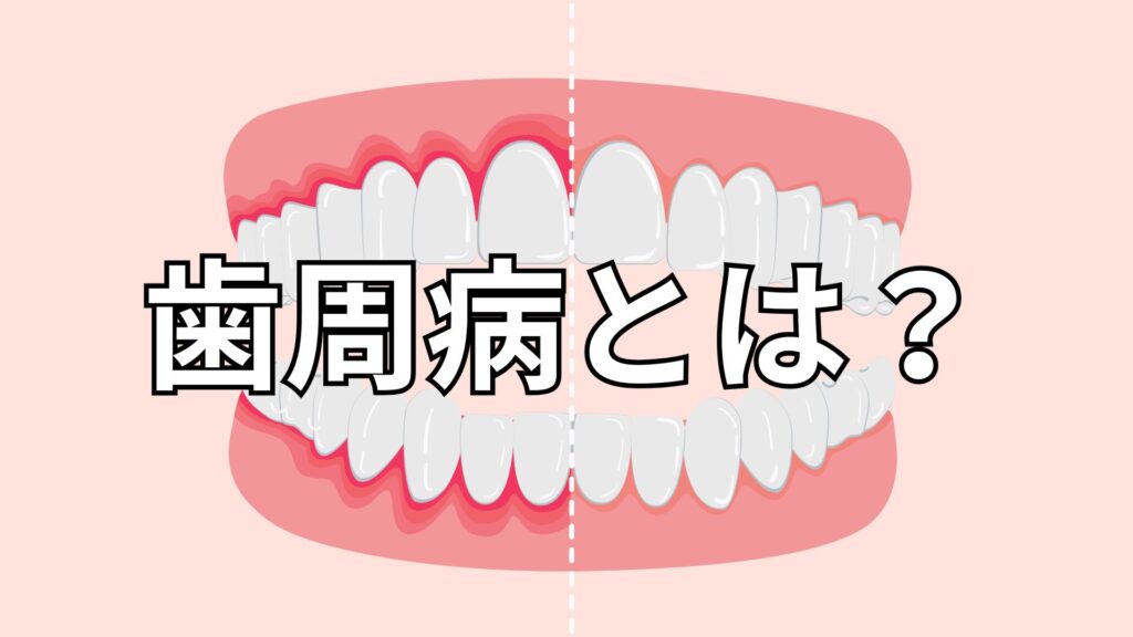 歯周病の歯茎と健康な歯茎