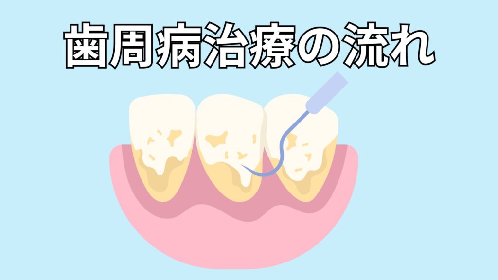 歯周病治療のイメージ
