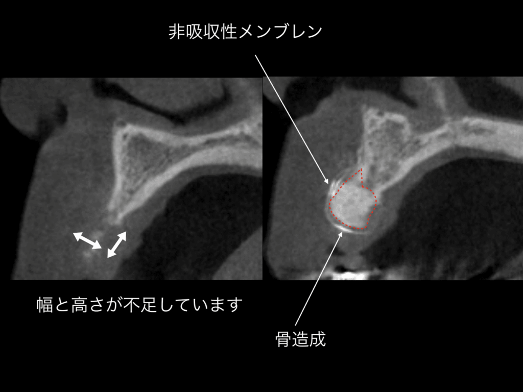 歯のレントゲン写真