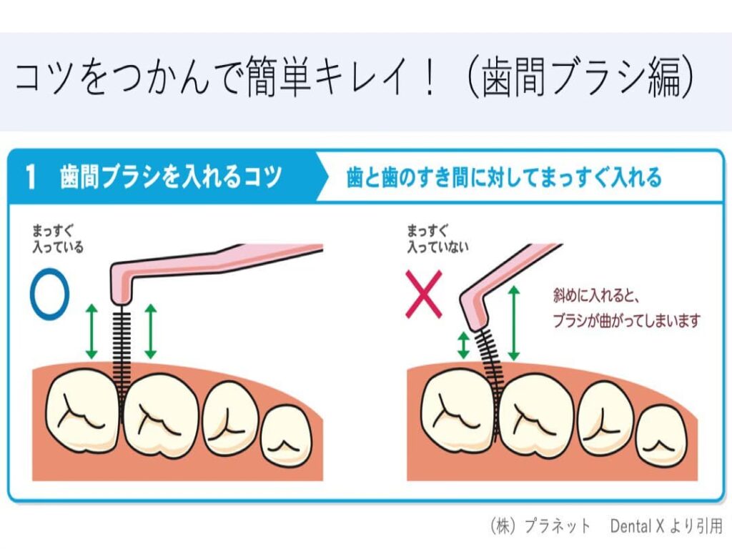 歯間ブラシを使用したプラークコントロール