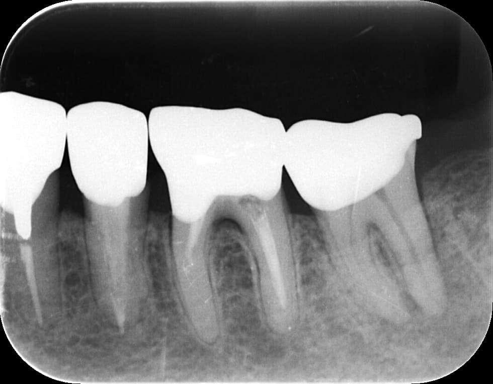歯の移動の様子①