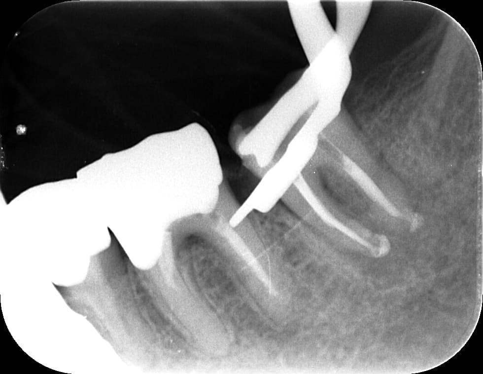 歯の移動の様子②