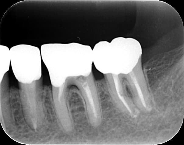 歯の移動の様子③