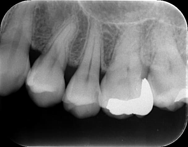 歯のレントゲン写真