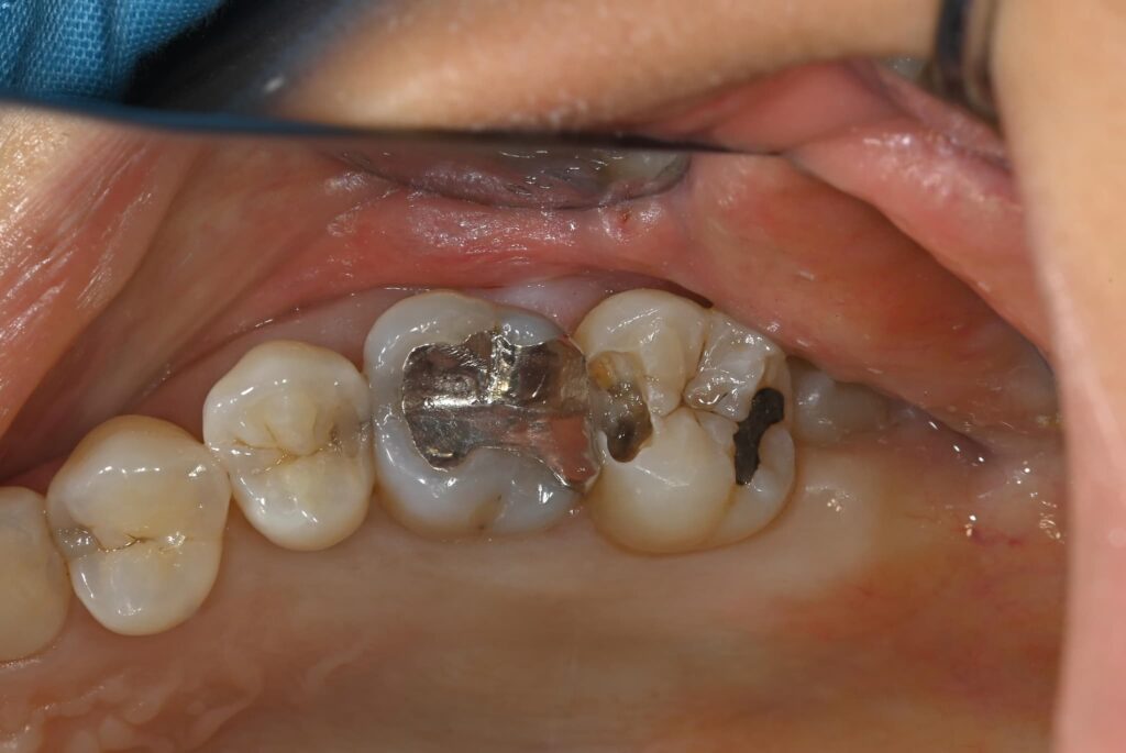 虫歯になった口腔内