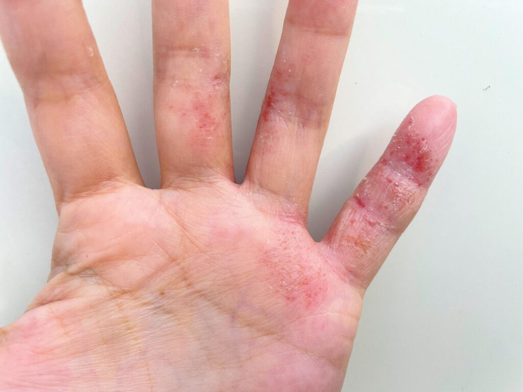 銀歯により金属アレルギーを発症した手