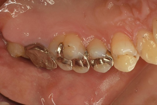 見た目以上に深刻なリスクを抱える銀歯