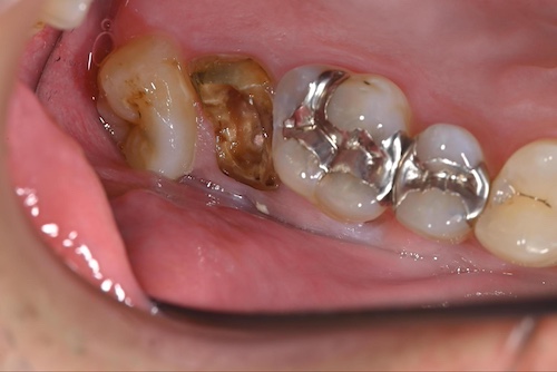 見た目以上に深刻なリスクを抱える銀歯