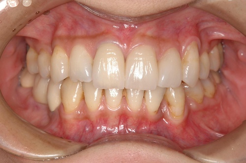 銀歯をセラミックなどの審美補綴（しんびほてつ）に変えて綺麗になった歯