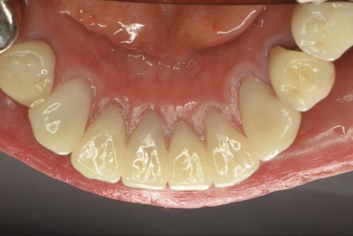 汚れが取れている歯