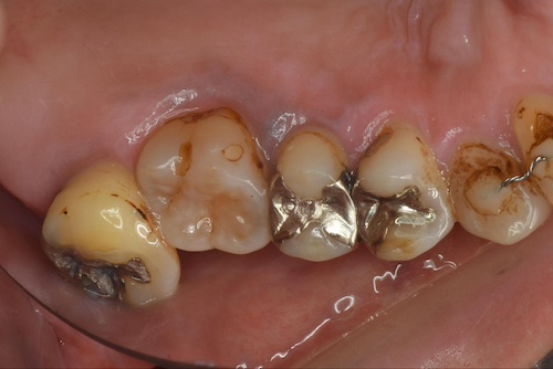 向かい合う歯が伸びてくる(挺出:ていしゅつ)