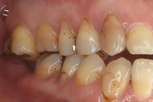 向かい合う歯が伸びてくる(挺出:ていしゅつ)