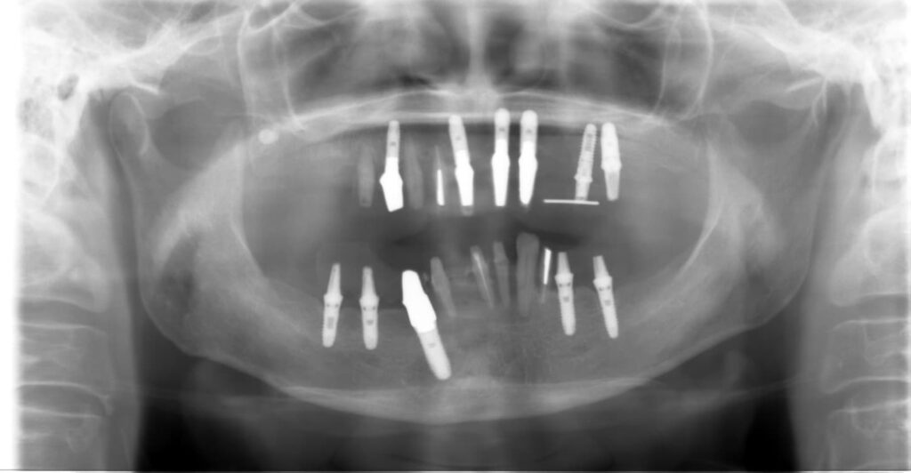 インプラント治療のレントゲン