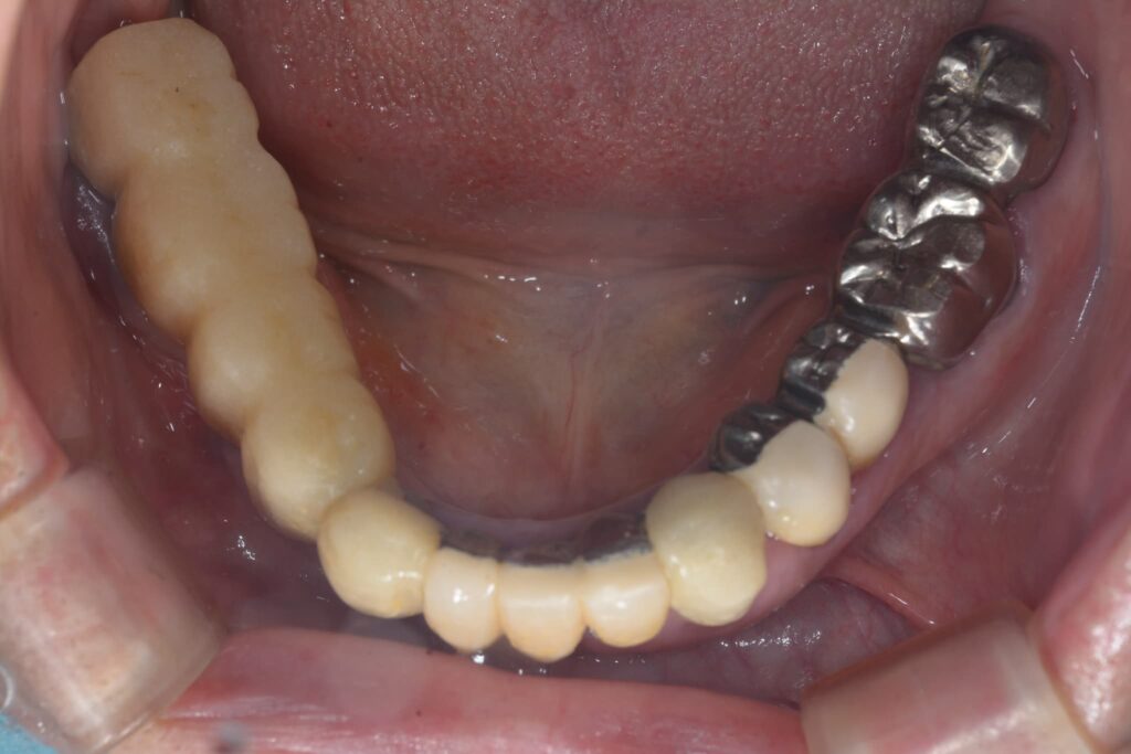 被せ物の破損・摩耗①