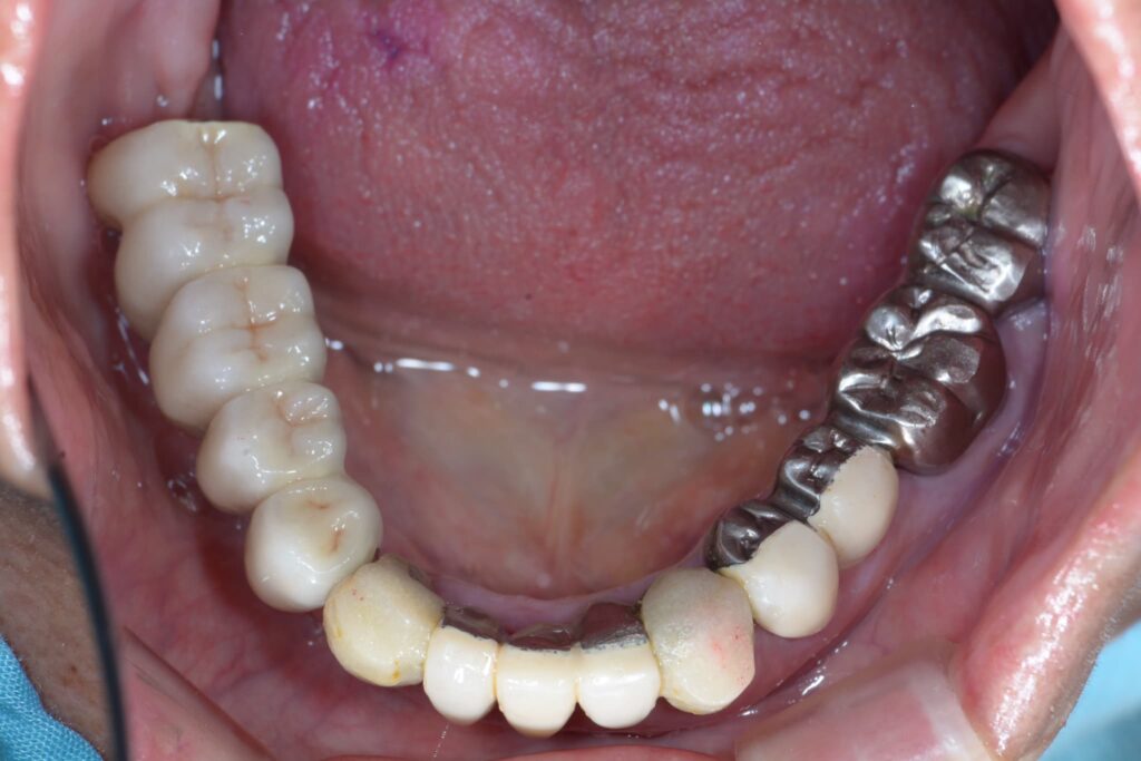 被せ物の破損・摩耗②